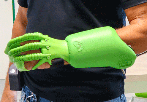 Die „exomotion hand one“ ist eine bionische Handorthese zur Wiederherstellung der Greiffunktion gelähmter Hände