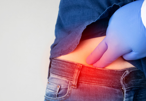 Morbus Crohn