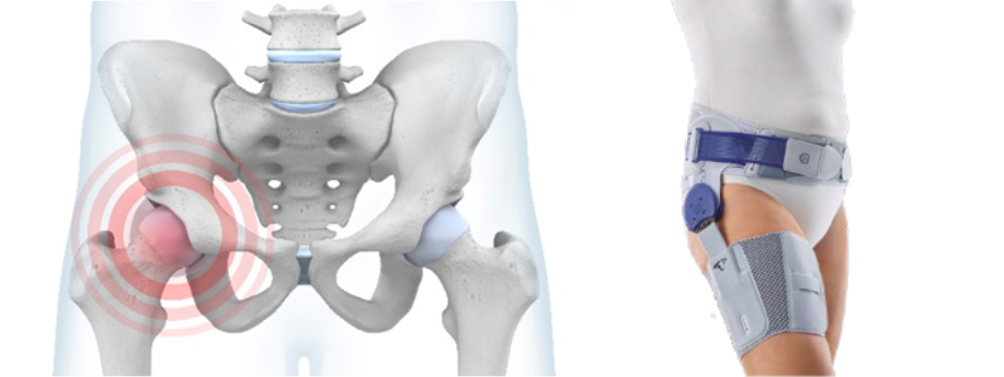 Coxarthrose Coxatrain