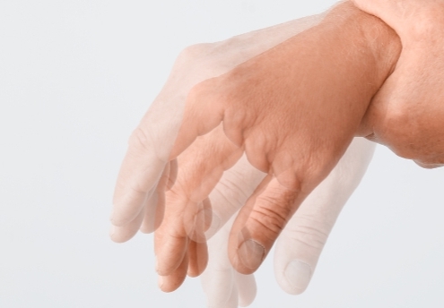 Tremore und Spastiken sind typische Parkinson-Symptome